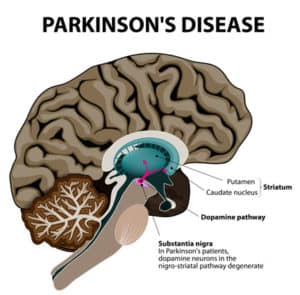 from blood letting to brain stimulation: 200 years of parkinson’s disease treatment