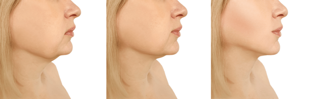 different treatments available for treating the double chin