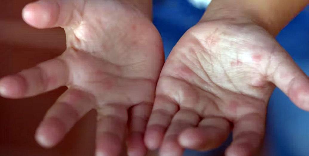 What is hand foot and mouth disease