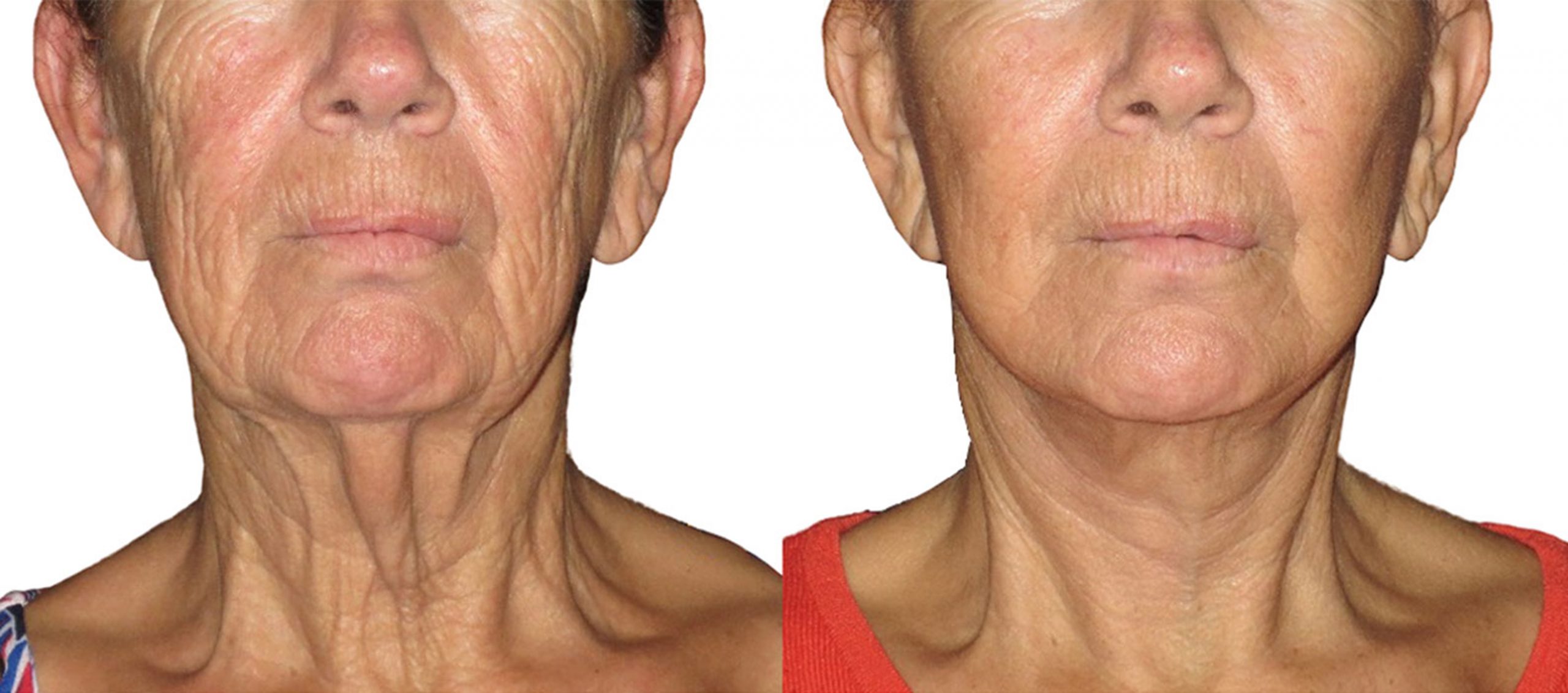 FACELIFT Answers From A Plastic Surgeon Dr Mark Duncan Smith   Facelift Perth Before And After Cosmetis Surgery Scaled 1 